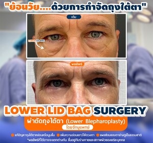 Image of Lower Eyebag surgery