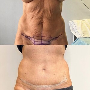 Image of Tummy tuck