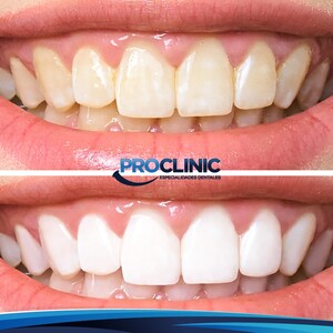 Image of Teeth whitening