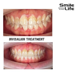 Image of Invisalign before and after