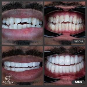 Image of Dentsun - Smile Makeover