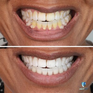 Image of Teeth whitening