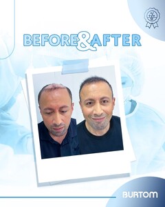 Image of Burtom Hair Transplant Center Gallery 0