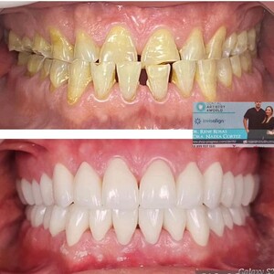 Image of Dental veneers