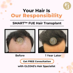 Image of Glojas Hair Transplant Malaysia Gallery 0