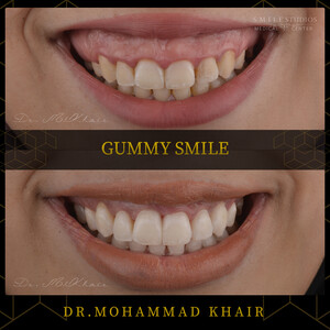 Image of Gummy smile