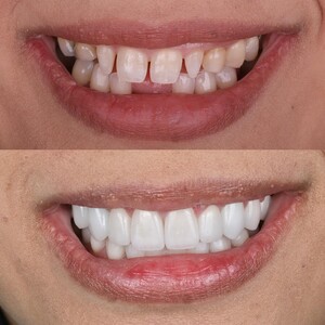 Image of Dental implants before and after