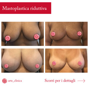 Image of Breast reduction