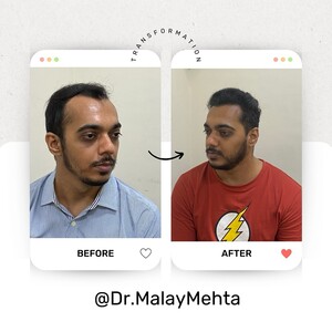 Image of Hair transplant results