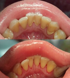 Image of Teeth cleaning