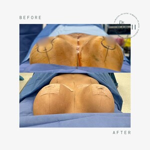 Image of Breast implant replacement