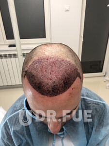 Image of Hair transplant before - Dr. FUE