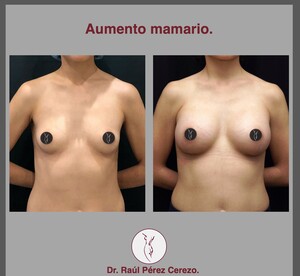 Image of Breast augmentation