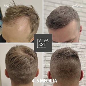 Image of FUE Hair transplant