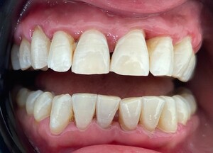 Image of Teeth cleaning