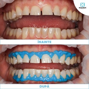 Image of Teeth whitening - Dent Park