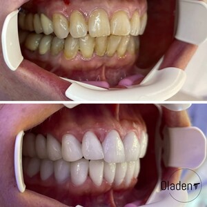 Image of Emax veneers