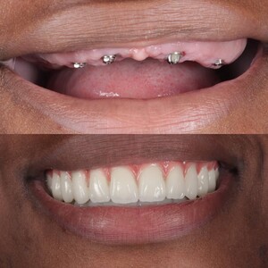 Image of Dental implants