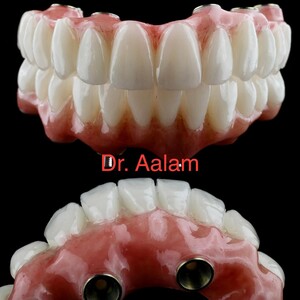 Image of Dental implants