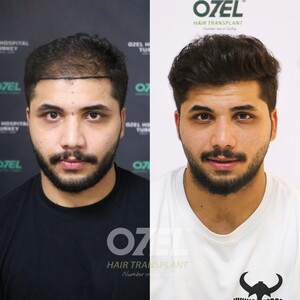 Image of Ozel Hair Transplant Gallery 2