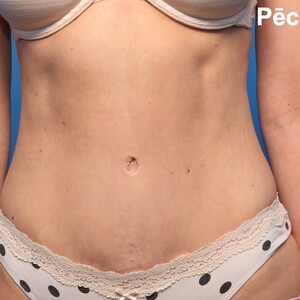 Image of After abdominoplasty - Dr Janis Gilis