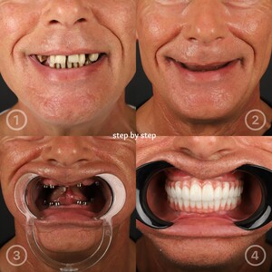 Image of Dental implants