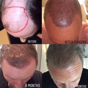 Image of Harris Hair Transplant UK Gallery 1