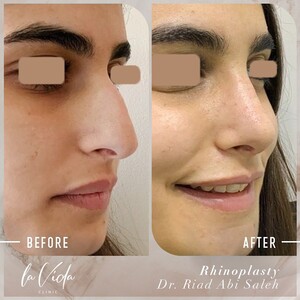 Image of Before and After Rhinoplasty