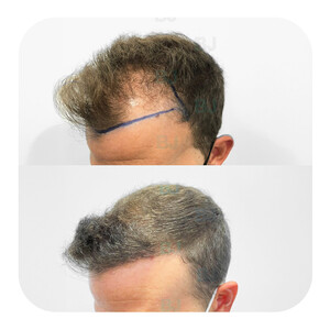 Image of Hair transplant before and after