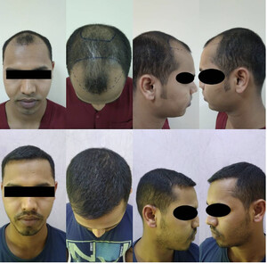 Image of Dr. Mukesh Batra Dermatologist Hair Transplant Gallery 3