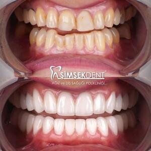 Image of Hollywood Smile Design - Şimşek Dent