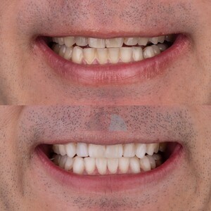 Image of Teeth whitening