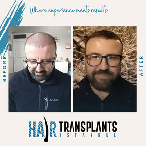 Image of Hair Transplant Istanbul (HTI) Gallery 1