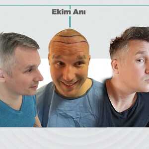 Image of DHI Hair transplant