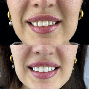 Image of Braces - Apolodor Dental Clinic