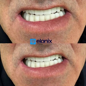 Image of Veneers