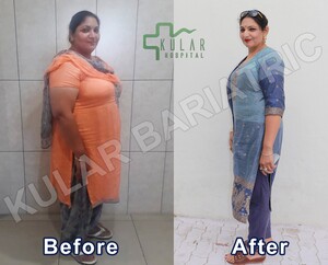 Image of Bariatric surgery before and after