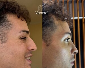 Image of Rhinoplasty before and after