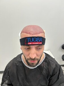 Image of Tuğba Hair Transplant Gallery 1