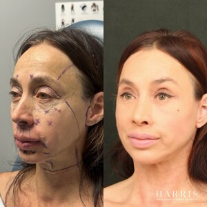 Image of Facelift