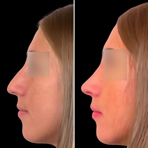 Image of Rhinoplasty