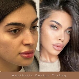 Image of Rhinoplasty - Aesthetic Design Turkey