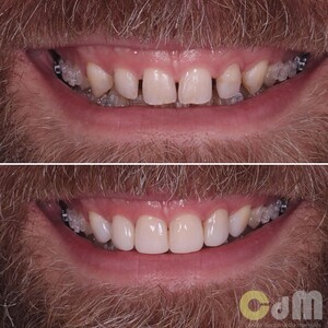 Image of Braces