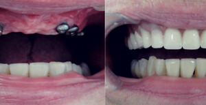 Image of Dental implants