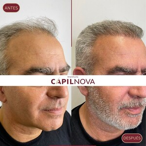 Image of Hair transplant