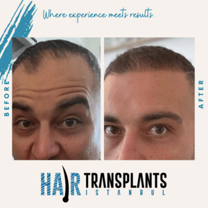 Image of Hair Transplant Istanbul (HTI) Gallery 3