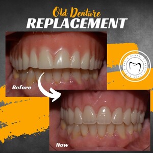 Image of Denture replacement