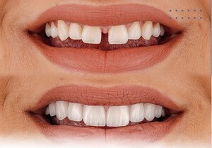 Image of Dental treatment before and after