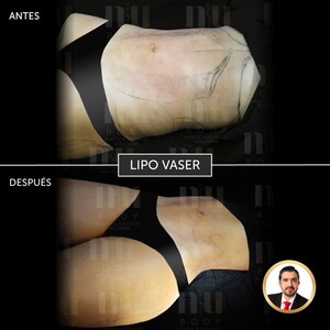 Image of Lipo Vaser