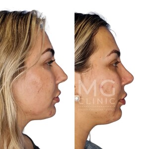 Image of Rhinoplasty - MG Clinic